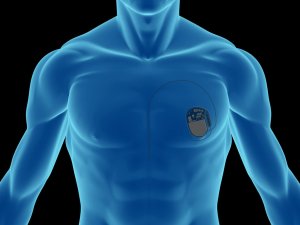 My Spouse's Pacemaker Is Not Working — What Can I Do?
