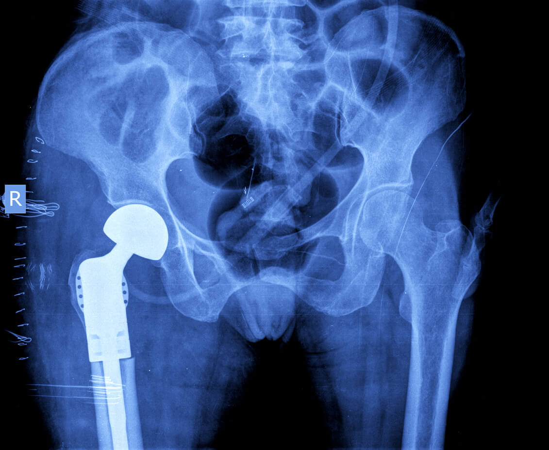 10 Common Medical Malpractice Issues with Hip Implants