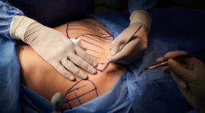 Plastic Surgery Malpractice: Do I Have a Case?